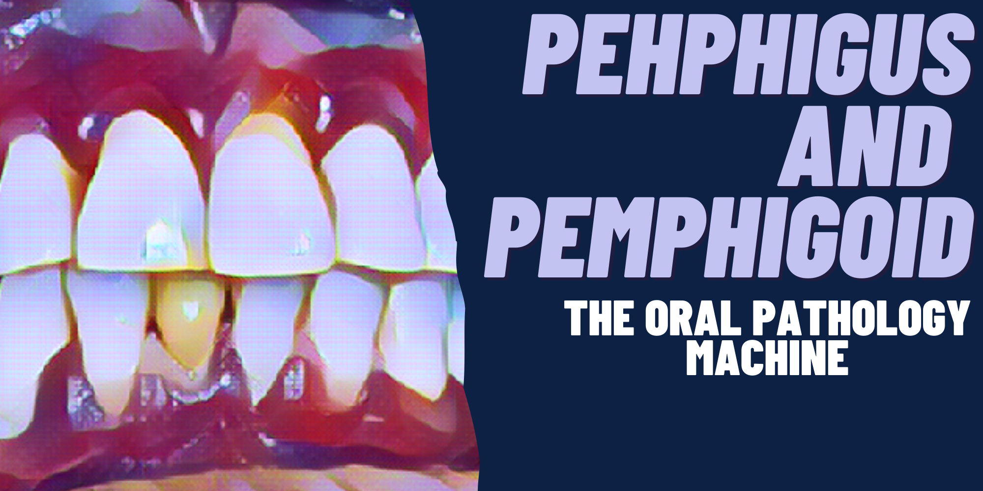 Pemphigus and Pemphigoid